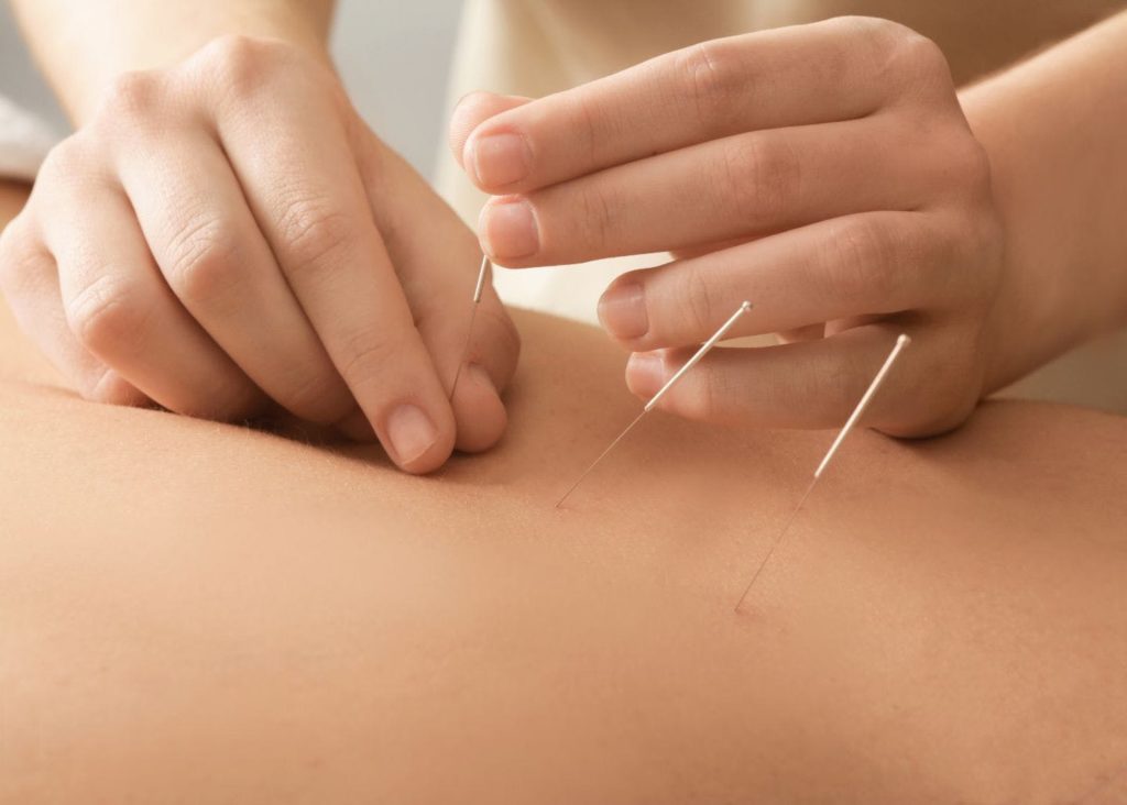 A person is using acupuncture needles on the back of their body.